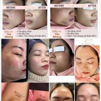 ELi Beauty Spa Aichi - Nám Mụn JP  (Nám Mụn JP)